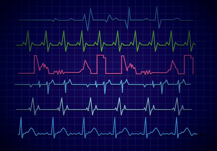 Waveform video technology Sick shine rate patient monitor medicine medical machine line introduction hospital heartbeat heart monitor heart graphic electrode Electrocardiography electrical doctor device Cardiology cardiologist Cardiac blue black Beating background 