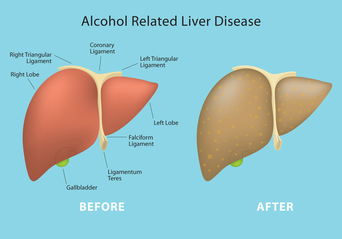 steatosis sick liver related poisoning pathology organ Liver lager labeled hepatic healthy liver gall fatty drinking display Disease cirrhosis bladder Before and After beer arld Alcoholic 