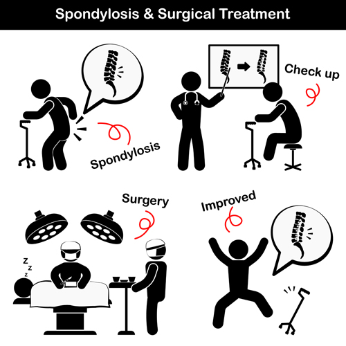 treatment surgery Spondylosis 